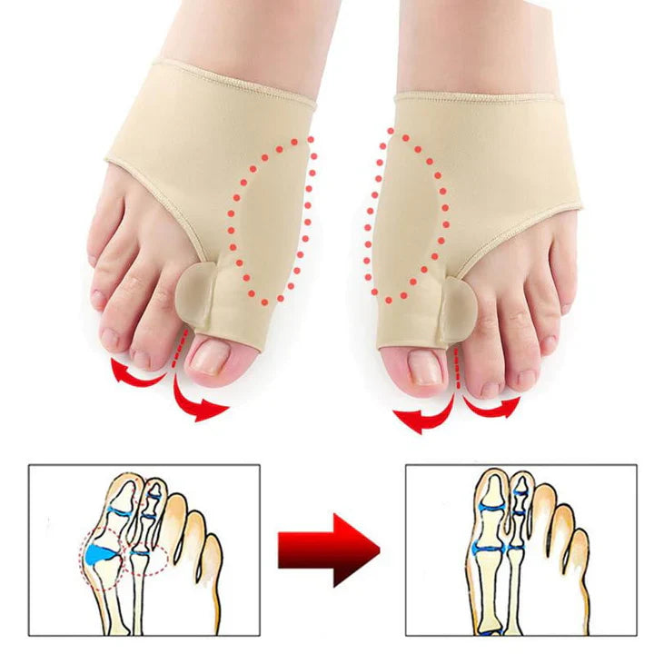 Hallux-Valgus Korrekturstütze (1 Paar) – Effektiver Schutz für Deine Füße